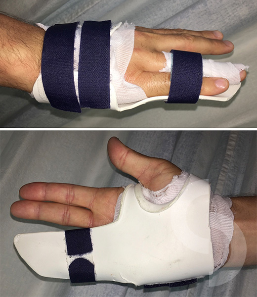 Custom Made Splint Used In Rehabilitation Of Finger Fractures Dr