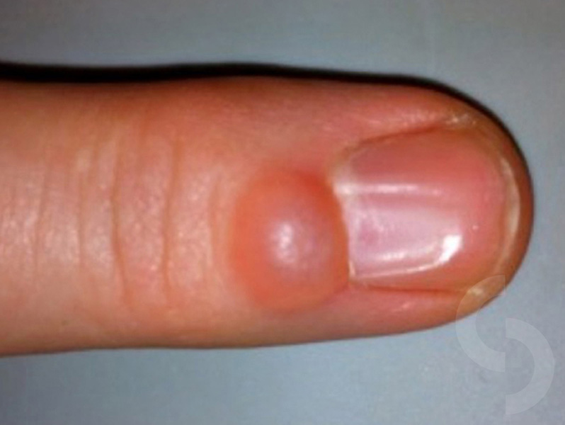 Finger Ganglion Mucous Cyst Dr Sonja Cerovac