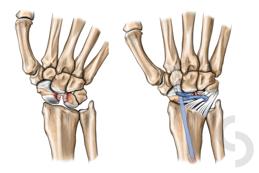 Wrist Ligament Injuries dr Sonja Cerovac