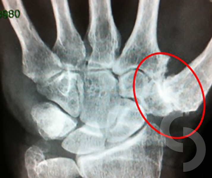 Thumb Basal Joint Arthritis dr Sonja  picture